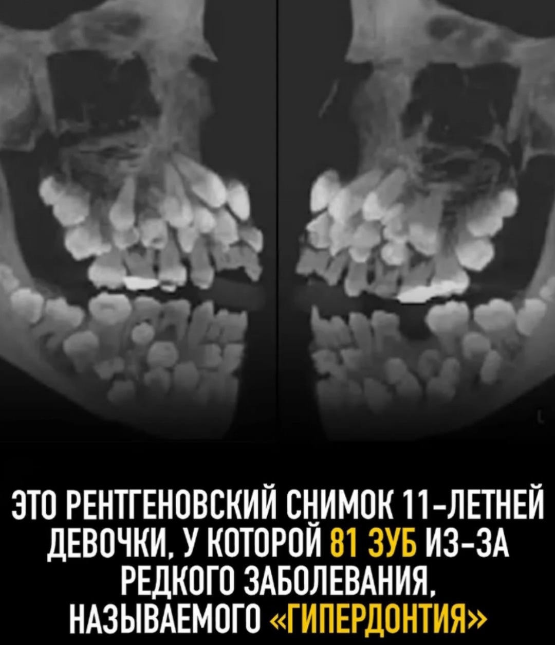Гипердонтия - уже уродующая патология