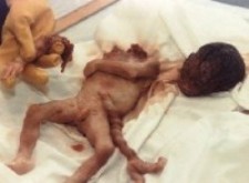 Аборт - изуродованное тельце младенца