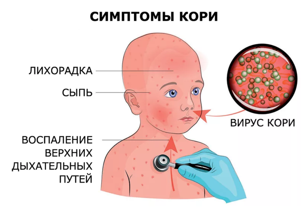 Симптомы кори - высокая температура, кашель, воспаление слизистых, сыпь - могут проявляться не сразу или напоминать сезонные простуды